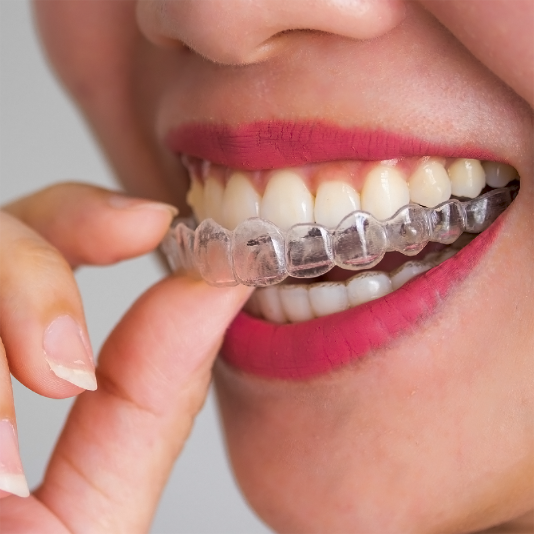 Invisalign